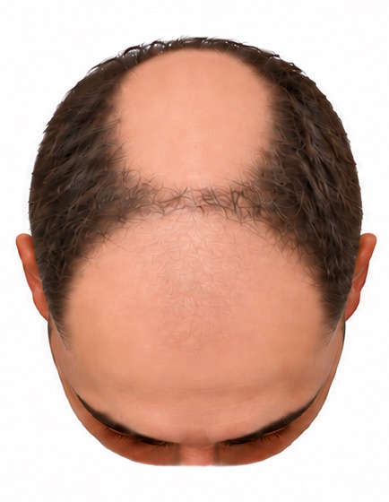Illustration of advanced male pattern loss before any transplant: the front of the scalp and the crown are bare with a narrow bridge of hair between them.