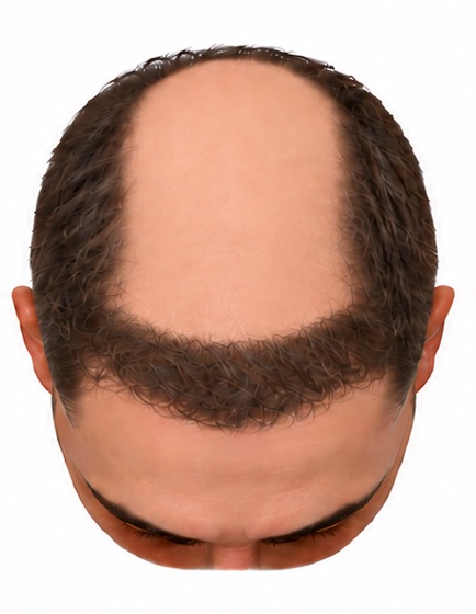 The same scalp restored with roughly 1,000 grafts: a band of hair at the front hairline and temple corners, with bare scalp directly behind it.