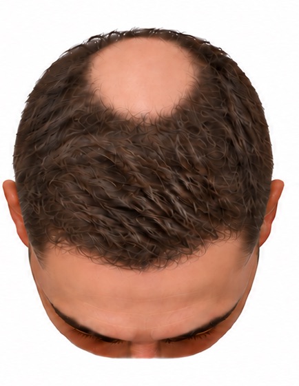 The same scalp restored with roughly 3,000 grafts: coverage reaching about two thirds of the way back, leaving a bare patch at the crown.